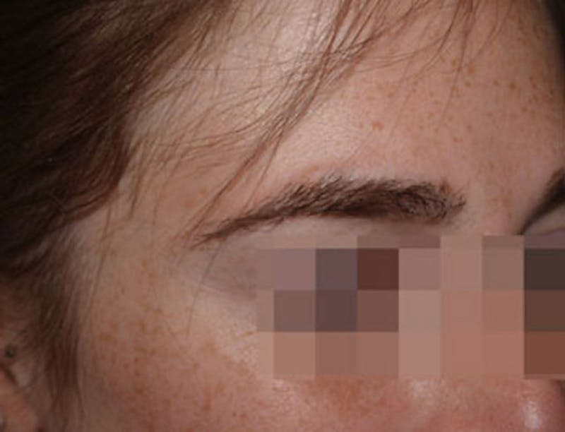 Eyebrow Transplantation Before & After Gallery - Patient 386696 - Image 6