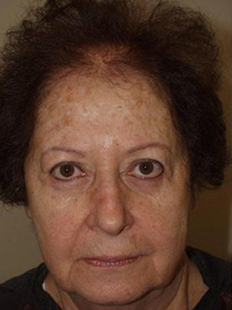 Hair Procedures for Women Before & After Gallery - Patient 333433 - Image 1