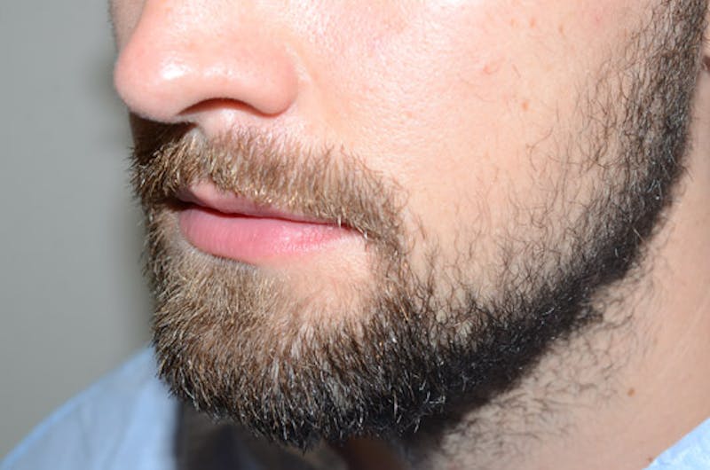 Facial Hair Transplant Before & After Gallery - Patient 153287 - Image 1