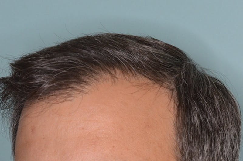 Hair Restoration for Men Before & After Gallery - Patient 146369 - Image 6