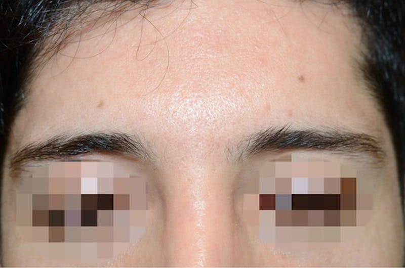 Eyebrow Transplantation Before & After Gallery - Patient 123948 - Image 1