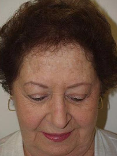 Hair Procedures for Women Before & After Gallery - Patient 402622 - Image 2