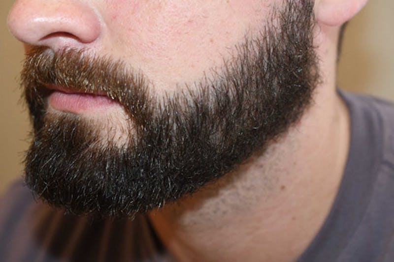 Facial Hair Transplant Before & After Gallery - Patient 153287 - Image 2