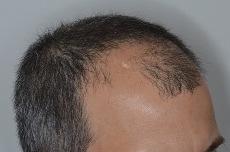 Hair Restoration for Men Before & After Gallery - Patient 146369 - Image 7