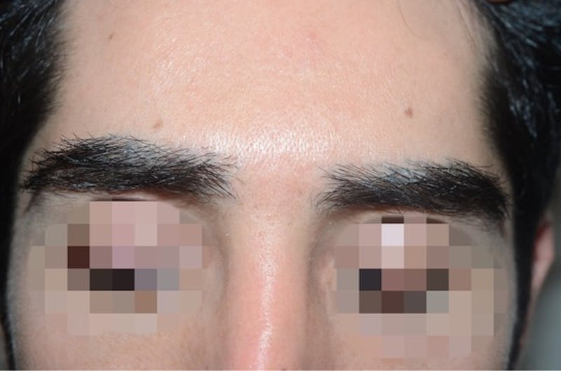 Eyebrow Transplantation Before & After Gallery - Patient 123948 - Image 2
