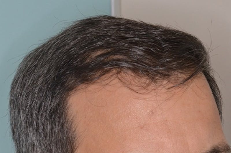 Hair Restoration for Men Before & After Gallery - Patient 146369 - Image 8