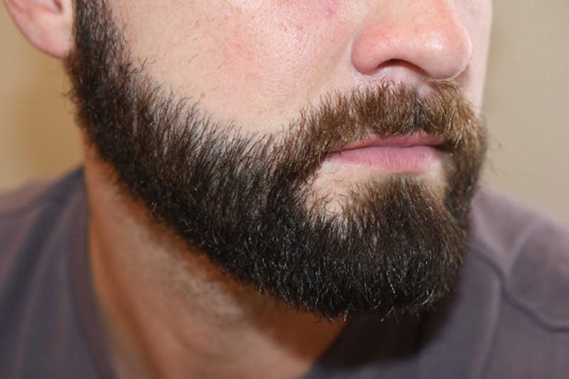 Facial Hair Transplant Before & After Gallery - Patient 153287 - Image 4