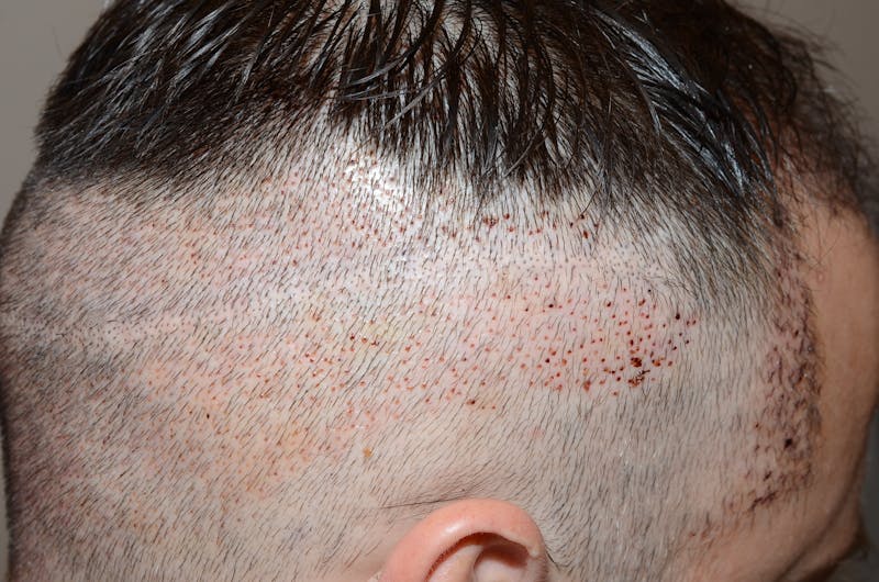 Scalp Micropigmentation Procedures Before & After Gallery - Patient 109773 - Image 4