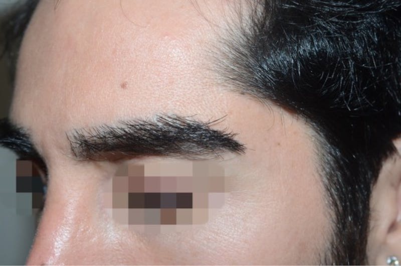 Eyebrow Transplantation Before & After Gallery - Patient 123948 - Image 4