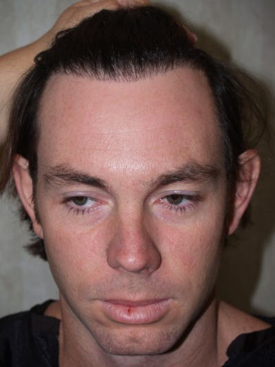 Hair Transplant Repair Before & After Gallery - Patient 370381 - Image 1