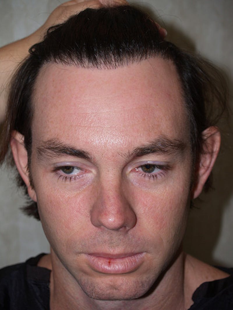 Hair Restoration for Men Before & After Gallery - Patient 222650 - Image 1