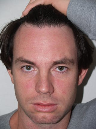 Hair Transplant Repair Before & After Gallery - Patient 370381 - Image 2