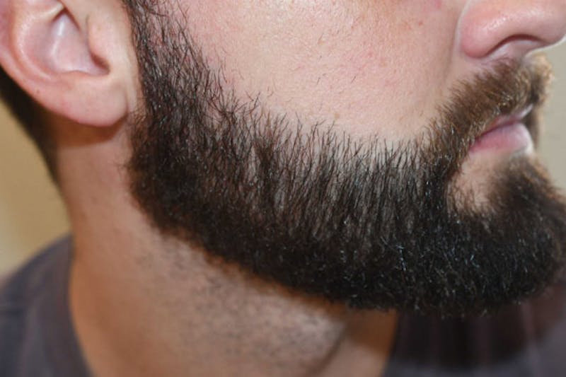 Facial Hair Transplant Before & After Gallery - Patient 153287 - Image 6