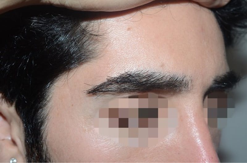 Eyebrow Transplantation Before & After Gallery - Patient 123948 - Image 6