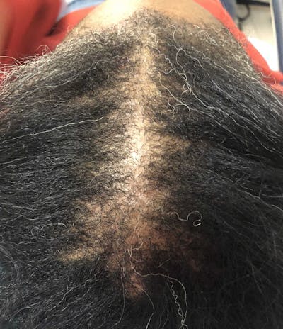 SMP Procedures Before & After Gallery - Patient 215416 - Image 1