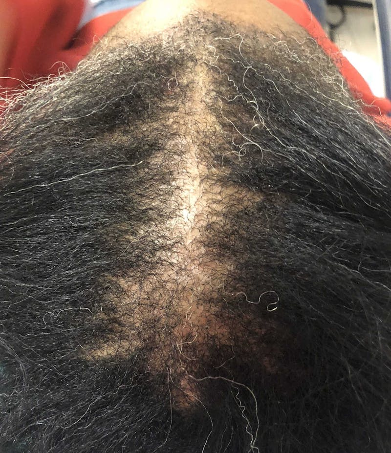 Scalp Micropigmentation Procedures Before & After Gallery - Patient 148273 - Image 1