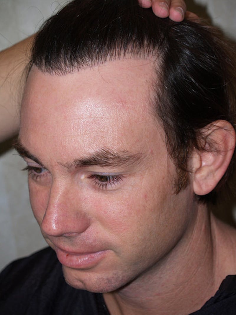 Hair Restoration for Men Before & After Gallery - Patient 222650 - Image 3