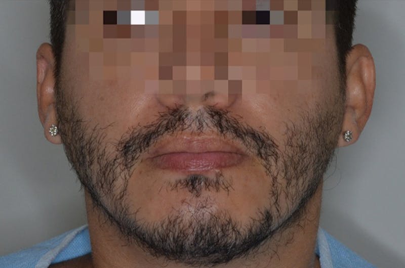 Facial Hair Transplant Before & After Gallery - Patient 617532 - Image 1