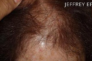 Hair Procedures for Women Before & After Gallery - Patient 333433 - Image 8
