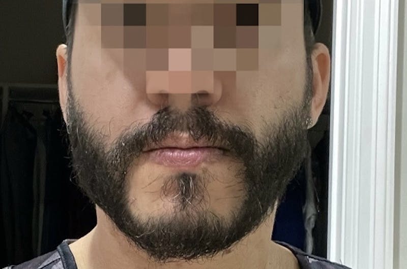 Facial Hair Transplant Before & After Gallery - Patient 617532 - Image 2