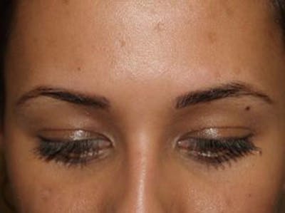 Eyebrow Transplantation Before & After Gallery - Patient 438069 - Image 1