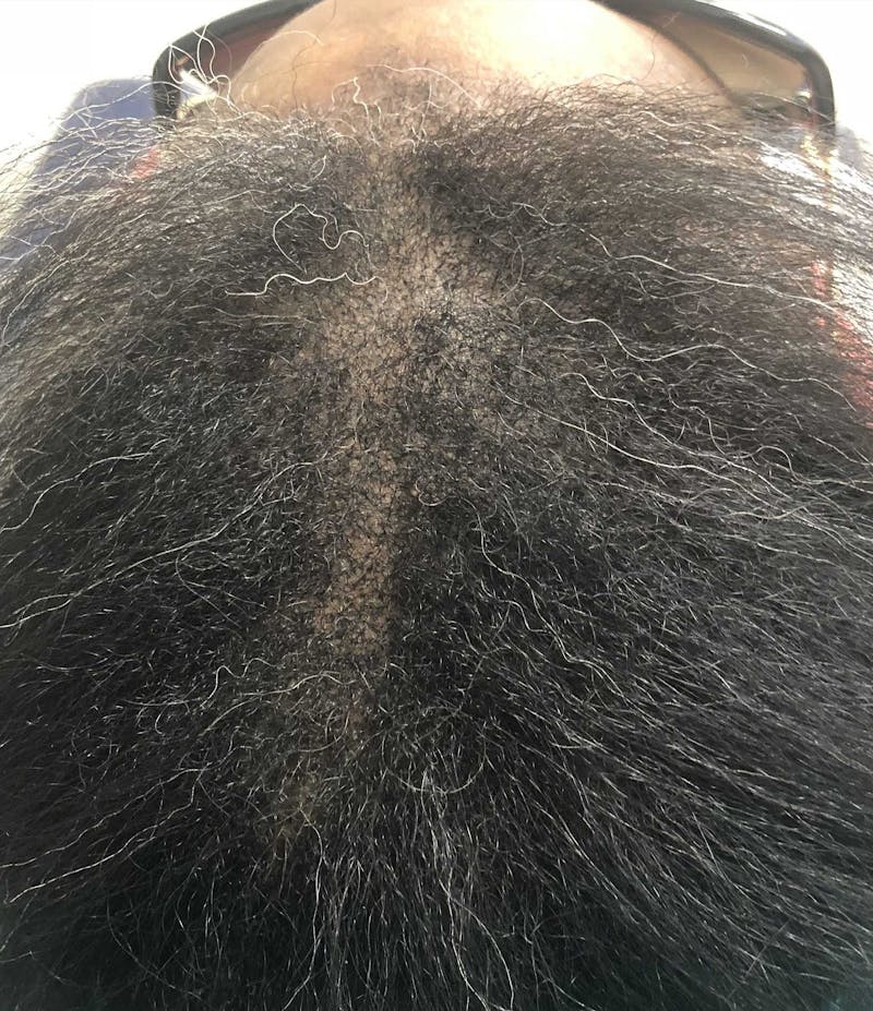 Scalp Micropigmentation Procedures Before & After Gallery - Patient 148273 - Image 2