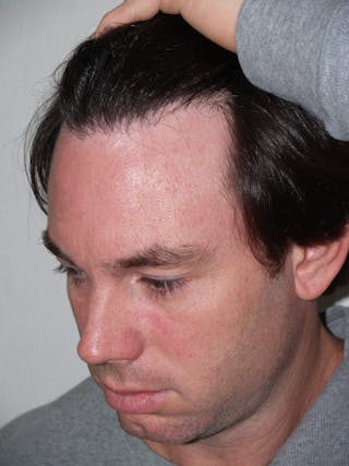 Hair Transplant Repair Before & After Gallery - Patient 370381 - Image 4
