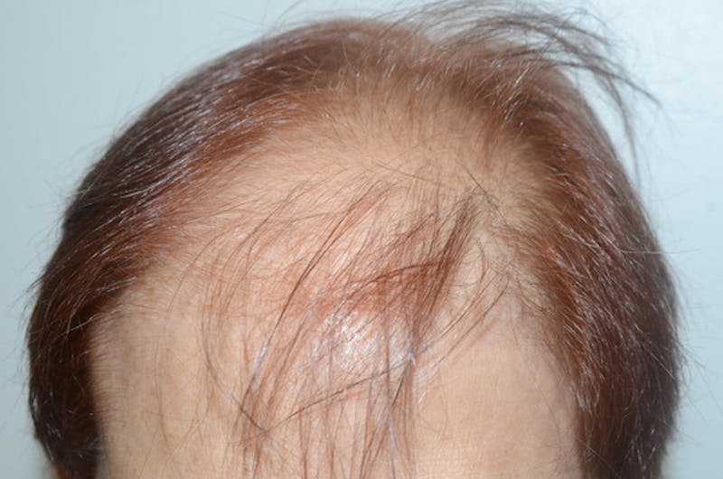 Hair Procedures for Women Before & After Gallery - Patient 387281 - Image 1