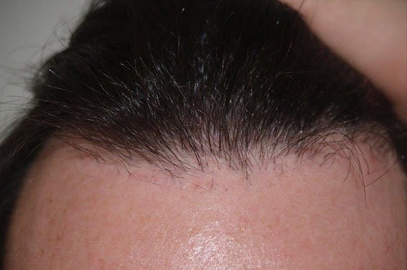 Hair Restoration for Men Before & After Gallery - Patient 222650 - Image 6