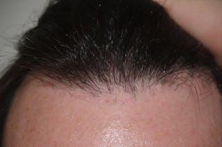 Hair Transplant Repair Before & After Gallery - Patient 370381 - Image 6
