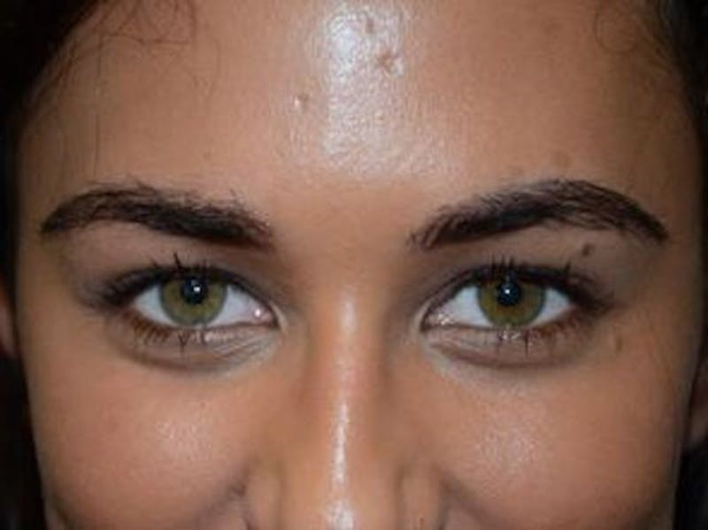Eyebrow Transplantation Before & After Gallery - Patient 295097 - Image 2
