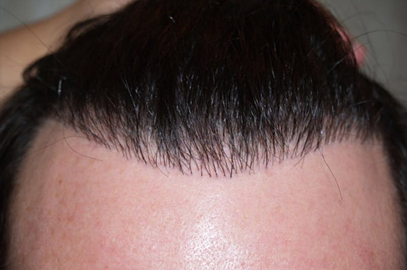 Hair Restoration for Men Before & After Gallery - Patient 222650 - Image 5