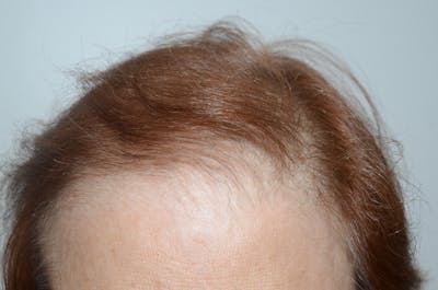 Hair Procedures for Women Before & After Gallery - Patient 347759 - Image 2