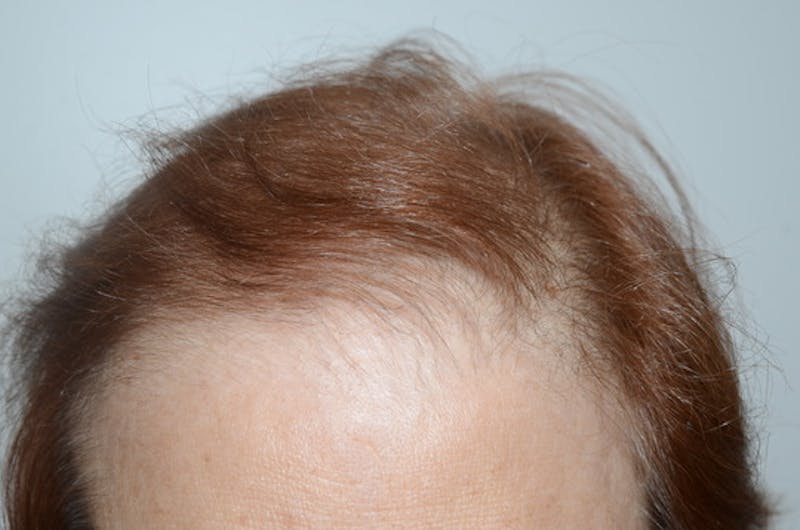 Hair Procedures for Women Before & After Gallery - Patient 387281 - Image 2