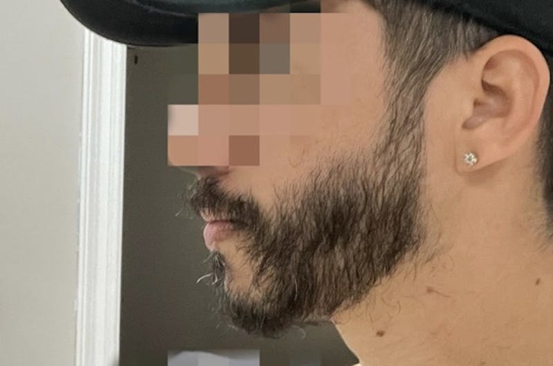 Facial Hair Transplant Before & After Gallery - Patient 617532 - Image 4