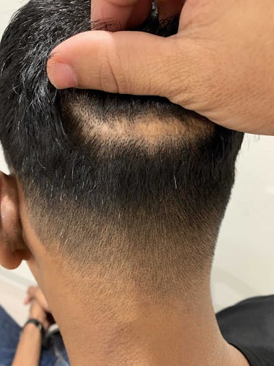 SMP Procedures Before & After Gallery - Patient 110636 - Image 1