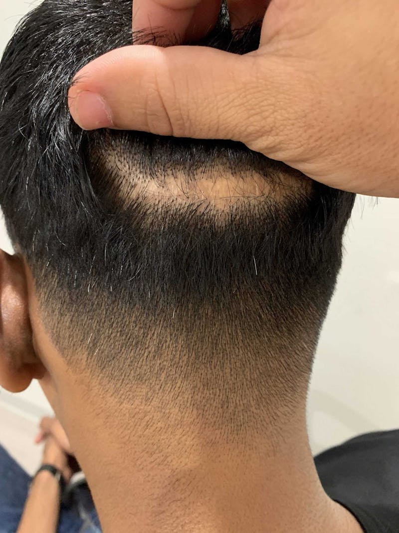 Scalp Micropigmentation Procedures Before & After Gallery - Patient 415686 - Image 1