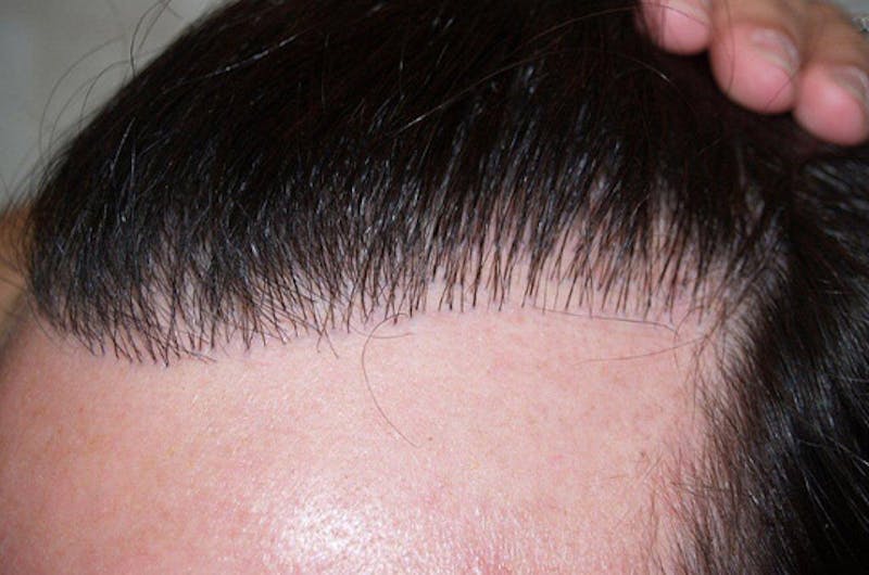 Hair Restoration for Men Before & After Gallery - Patient 222650 - Image 7