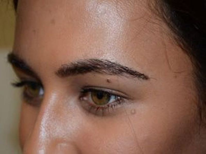 Eyebrow Transplantation Before & After Gallery - Patient 295097 - Image 4