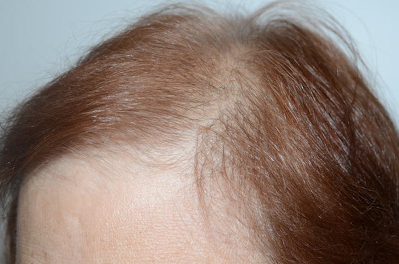 Hair Procedures for Women Before & After Gallery - Patient 387281 - Image 4
