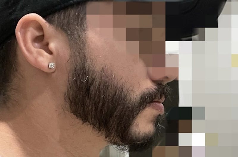 Facial Hair Transplant Before & After Gallery - Patient 617532 - Image 6