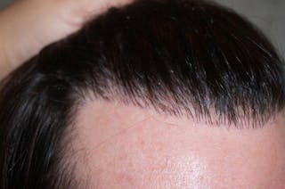 Hair Transplant Repair Before & After Gallery - Patient 370381 - Image 10