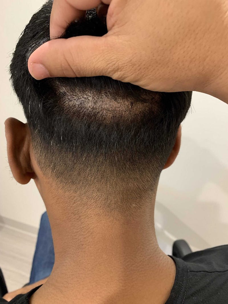 Scalp Micropigmentation Procedures Before & After Gallery - Patient 415686 - Image 2