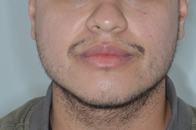 Facial Hair Transplant Before & After Gallery - Patient 285937 - Image 1