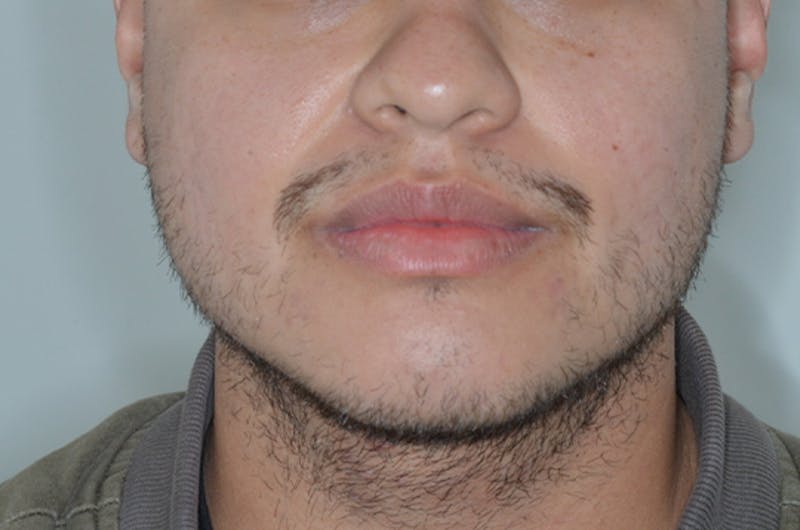 Facial Hair Transplant Before & After Gallery - Patient 241085 - Image 1
