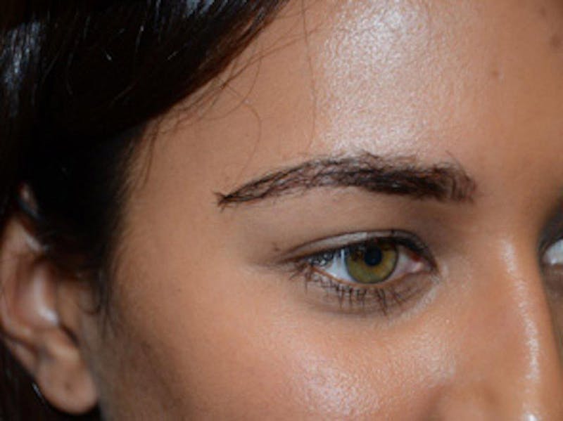 Eyebrow Transplantation Before & After Gallery - Patient 295097 - Image 6