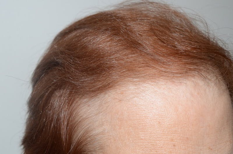 Hair Procedures for Women Before & After Gallery - Patient 387281 - Image 6