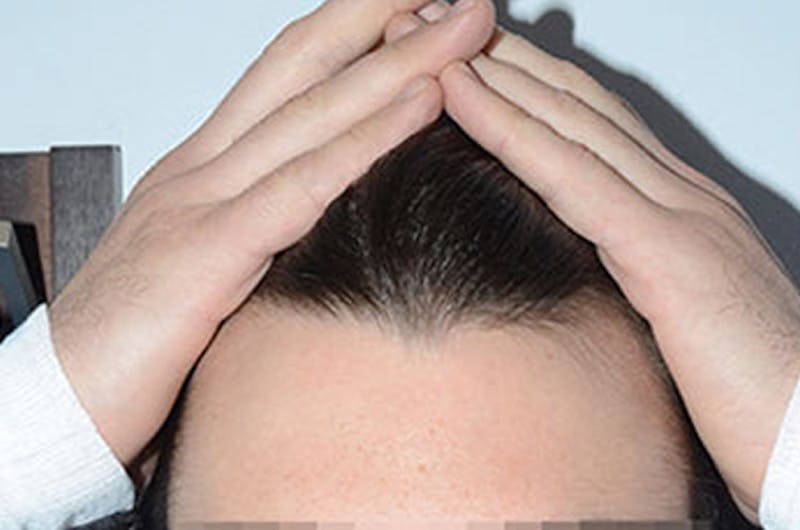 Hair Restoration for Men Before & After Gallery - Patient 239786 - Image 1