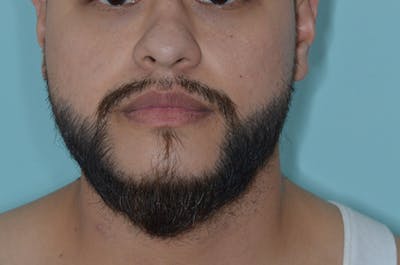 Facial Hair Transplant Before & After Gallery - Patient 285937 - Image 2