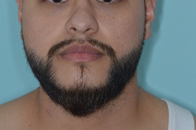 Facial Hair Transplant Before & After Gallery - Patient 241085 - Image 2